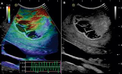 Comparison of Intraoperative Ultrasound B-Mode and Strain Elastography for the Differentiation of Glioblastomas From Solitary Brain Metastases. An Automated Deep Learning Approach for Image Analysis